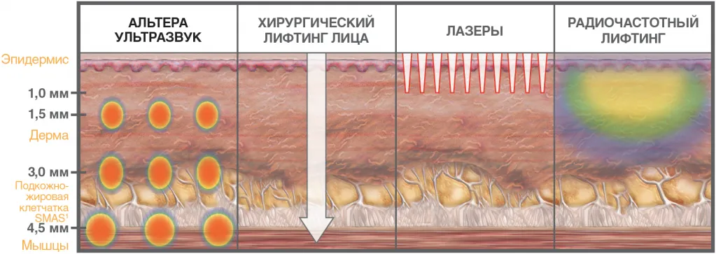 ulthera_glubina.png ulthera_glubina.png