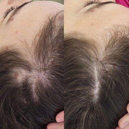 Профилактика выпадения и стимуляция роста волос 