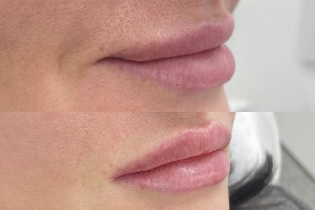 Коррекция формы губ